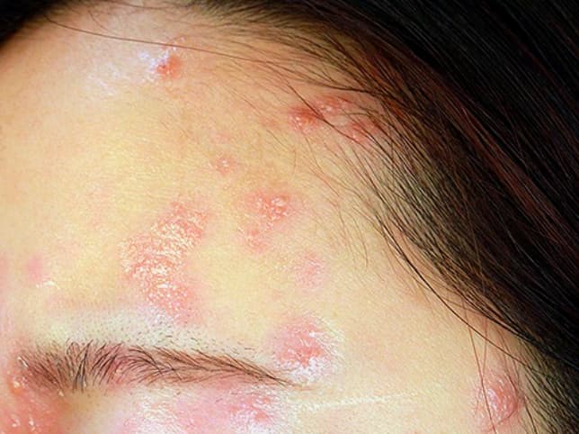 얼굴대상포진증상