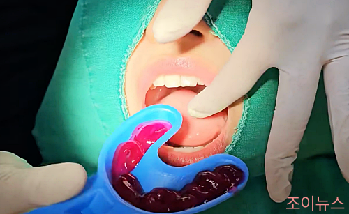 불소 도포 과정_이미지출처: 임플란티아TV