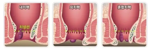 치핵