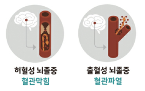 허혈성 vs 출혈성 뇌졸중 비교