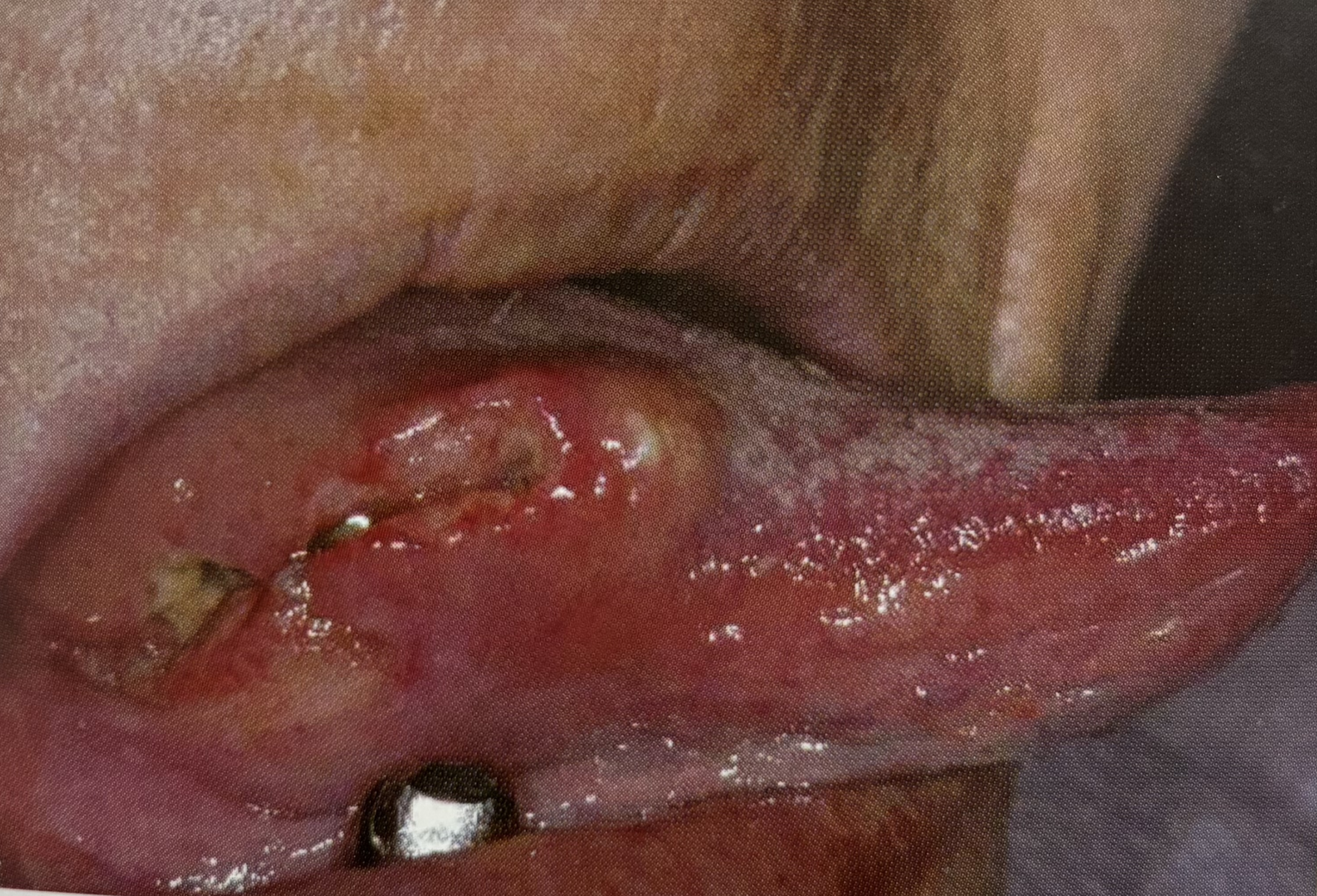 대표적인 구강암인 '편평상피암종'. 혀의 후방부 측면에 발생하였다.