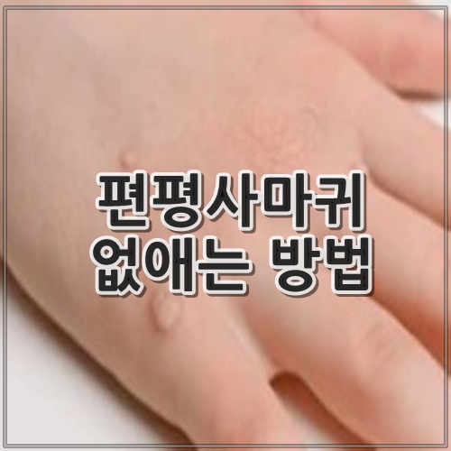 편평사마귀 없애는 방법