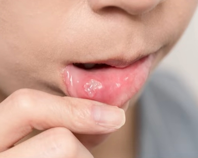 입술 수포 원인