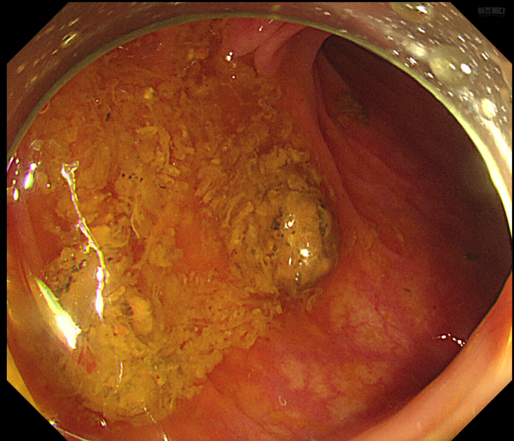 대장내시경 전 음식주의사항