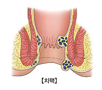치질 수술