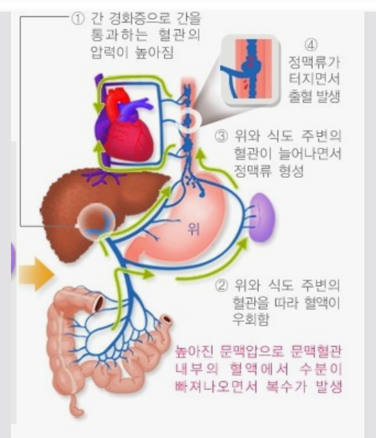 간경화증-복수-출혈