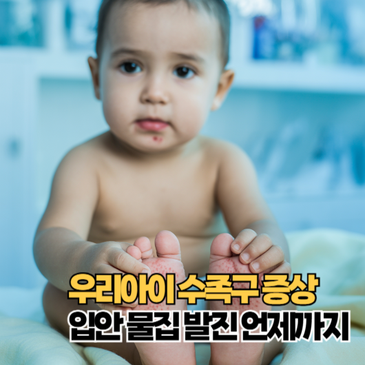 수족구 증상, 아이 입안 물집 발진 언제까지