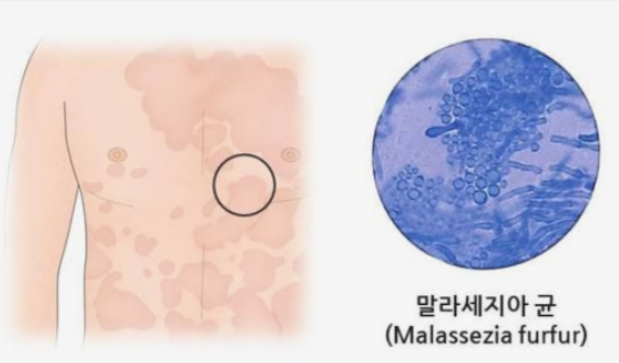 마랄세지아균 이미지