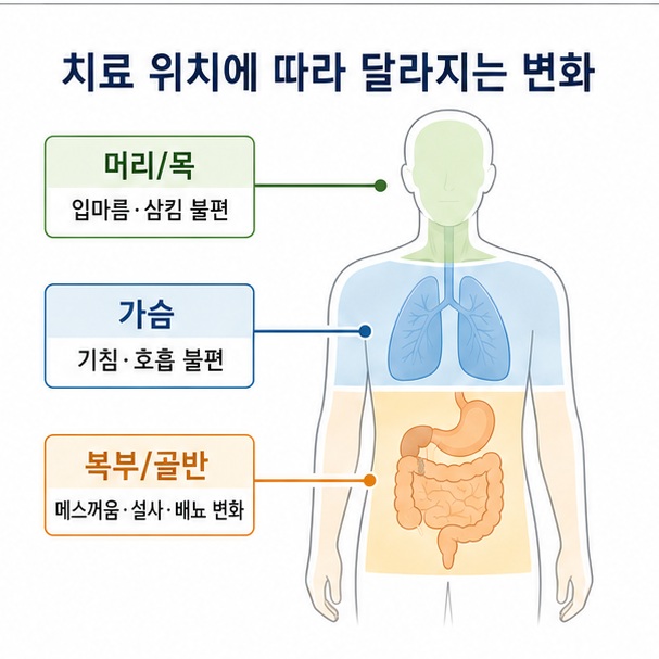 머리·목, 가슴, 복부·골반에 따라 달라지는 방사선치료 부작용을 인체 도해로 비교한 이미지