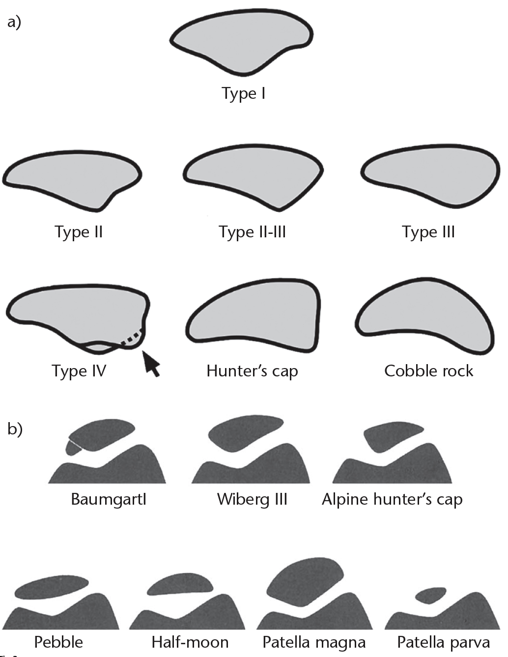 Differenttypesofpatellarshpae-슬개골타입형상