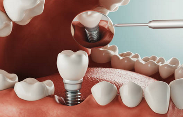 임플란트 시술과정