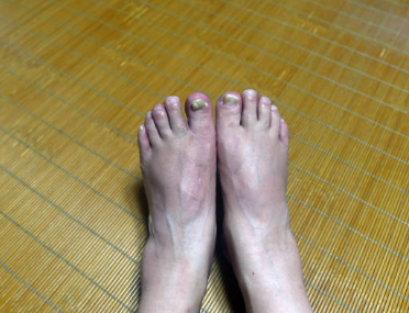 손발톱 진균 곰팡이