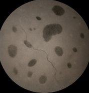 망막 박리 증상