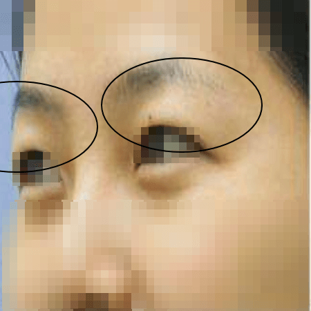 절개법 쌍커풀 수술 전 여성의 모습