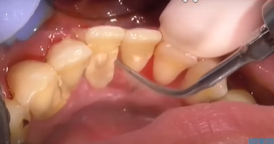 치석-떨어짐-구멍