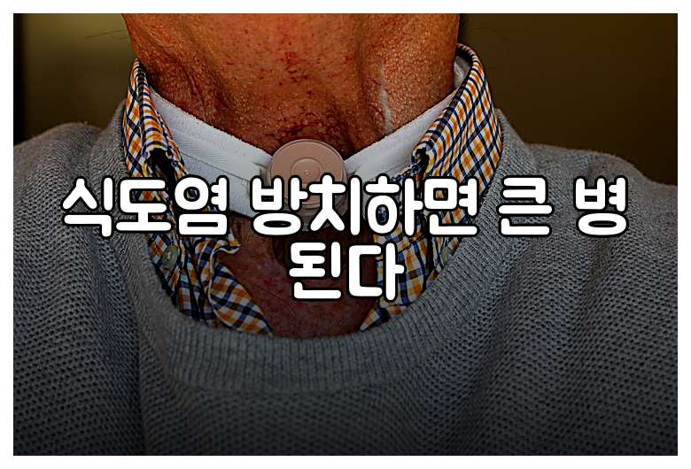 식도염 방치하면 큰 병 된다