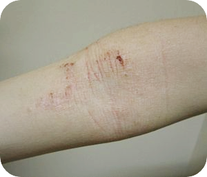 달맞이꽃종자유-효능