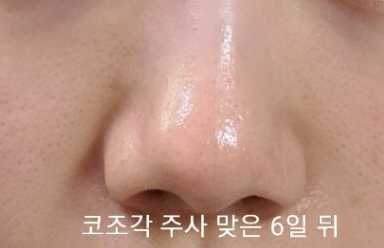 코조각주사 후기