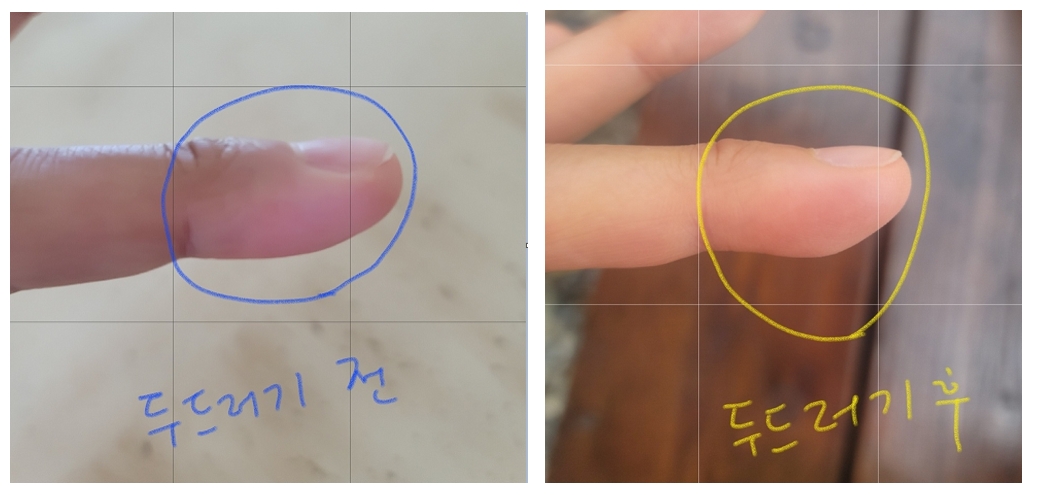 한랭-두드러기