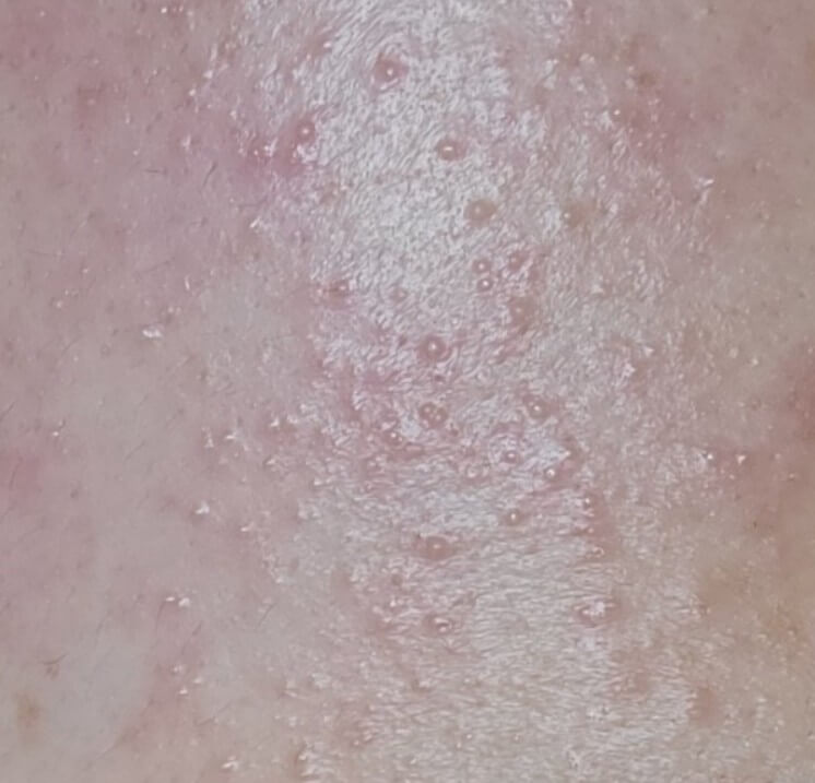 좁쌀 여드름 난 모습