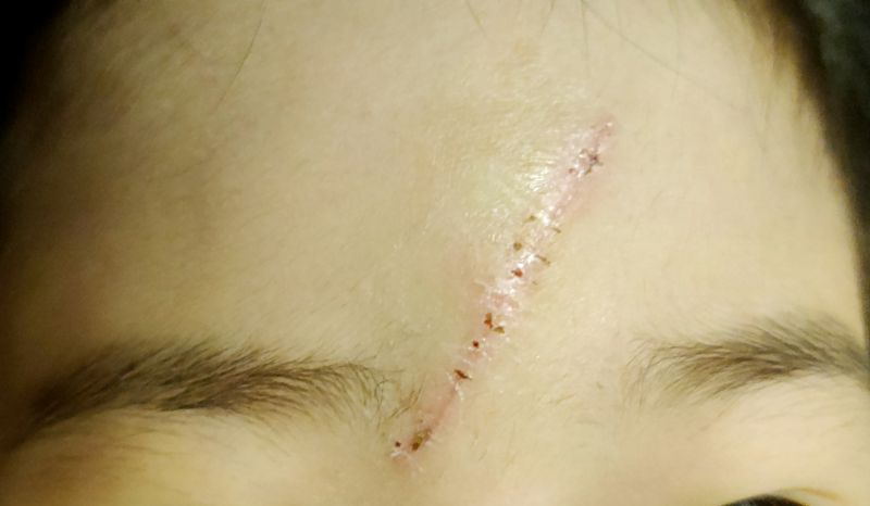 실밥을 제거 하고난후 실밥 모양으로 남은 딱지들