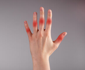 루프스 병 (systemic lupus erythematosus), 전신성 홍반성 원인과 증상에 대해 알아봤습니다. 매우 생소한 이름인데요. 얼굴에 나비 모양으로 발진이 일어났다면 한번쯤은 의심해봐야 합니다. 루프스 병은 어디 병원으로 가야 하는지와 치료방법까지 천천히 읽어 보시기 바랍니다.