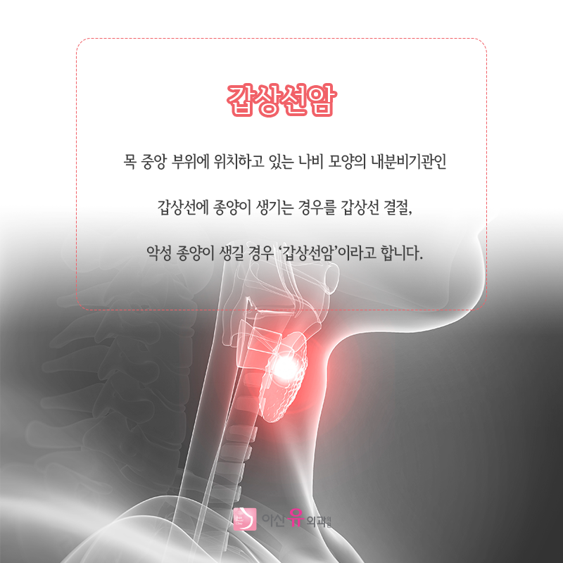 갑상선암