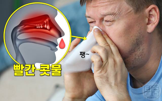 콧물 색깔별 증상,빨간색 콧물 색깔로 보는 건강