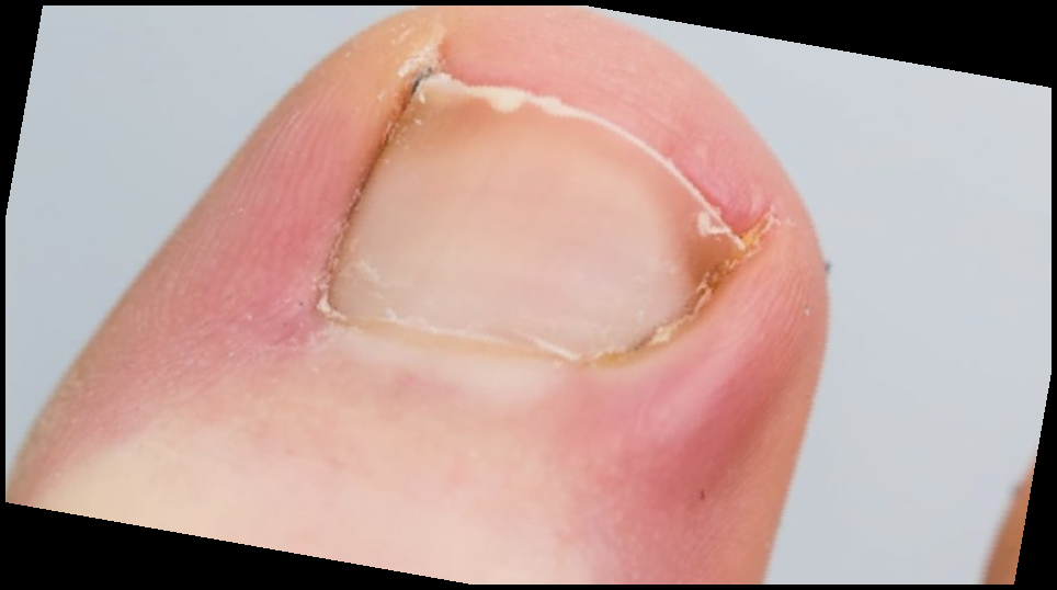 내성발톱 자가치료