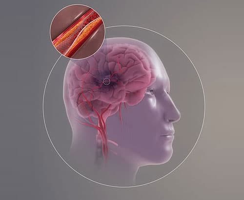 뇌졸중 전조증상