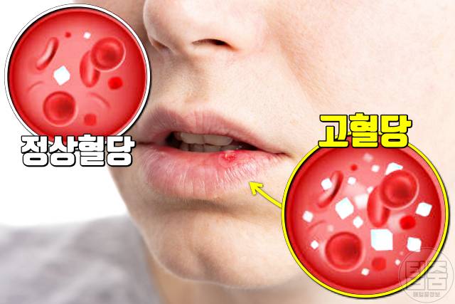 당뇨 증상 피부 상처 당뇨 걸리는 식습관