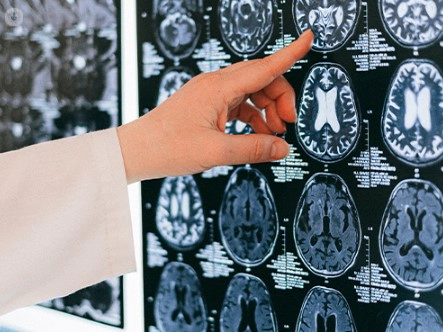 뇌출혈 수술 방법