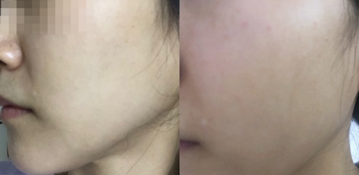 글루타치온미백효과