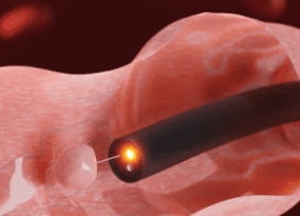 대장내시경 전 음식 주의사항과 대장내시경 약 복용법