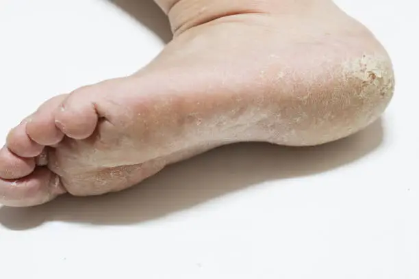 발가락 사이 무좀 치료법