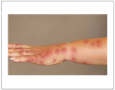 빈대 퇴치법과 효과적인 빈대 퇴치제