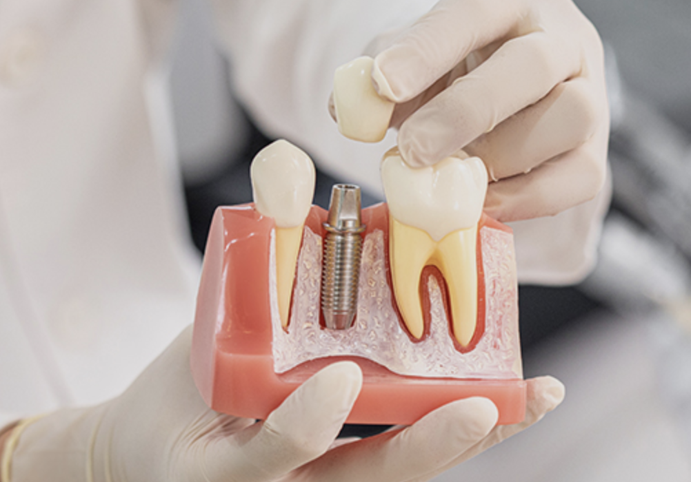 덴티스 임플란트 가격