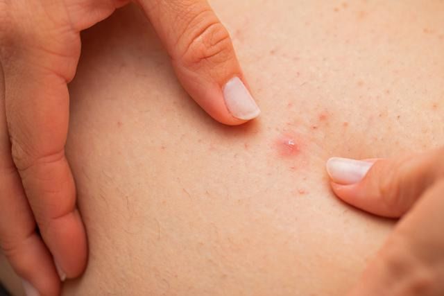 종기가 생기는 이유