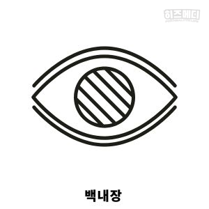 백내장 증상 원인