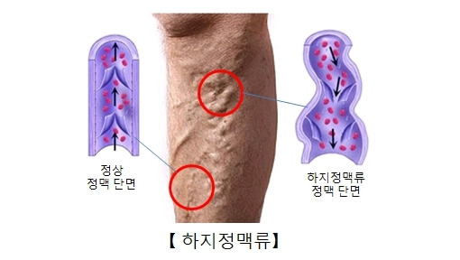 썸네일-하지정맥류-가로사진