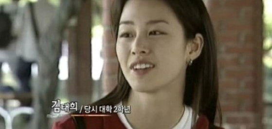 임플란트 후 교정 김태희 수지 효과