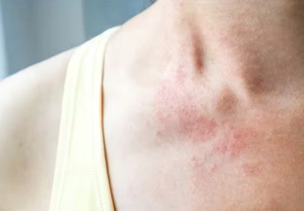 대상포진 자주 묻는 질문 FAQ