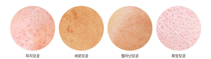 모공의 종류