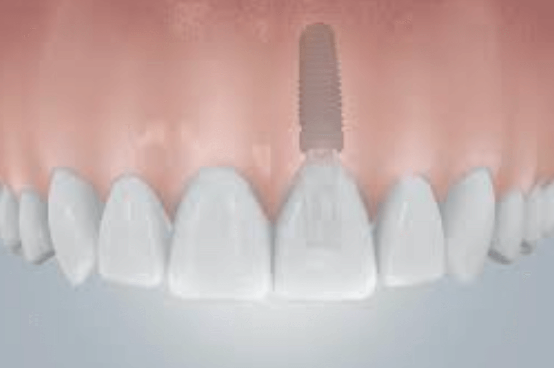 앞니 임플란트 가격