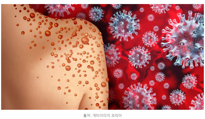 원숭이두창 증상으로 수포가 어깨에 올라온 염증이 표현된 그림이다.