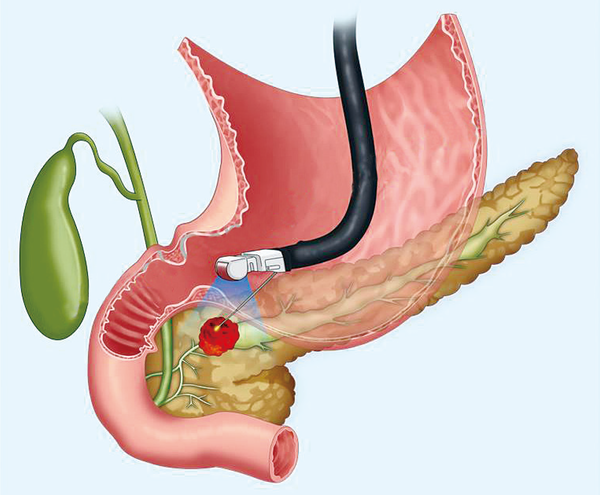 췌장암 검사방법