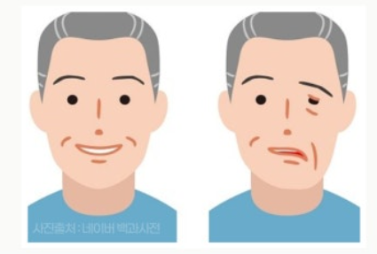안면마비 예방을 위한 생활 습관