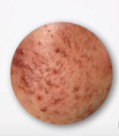 여드름 색소 침착 예시