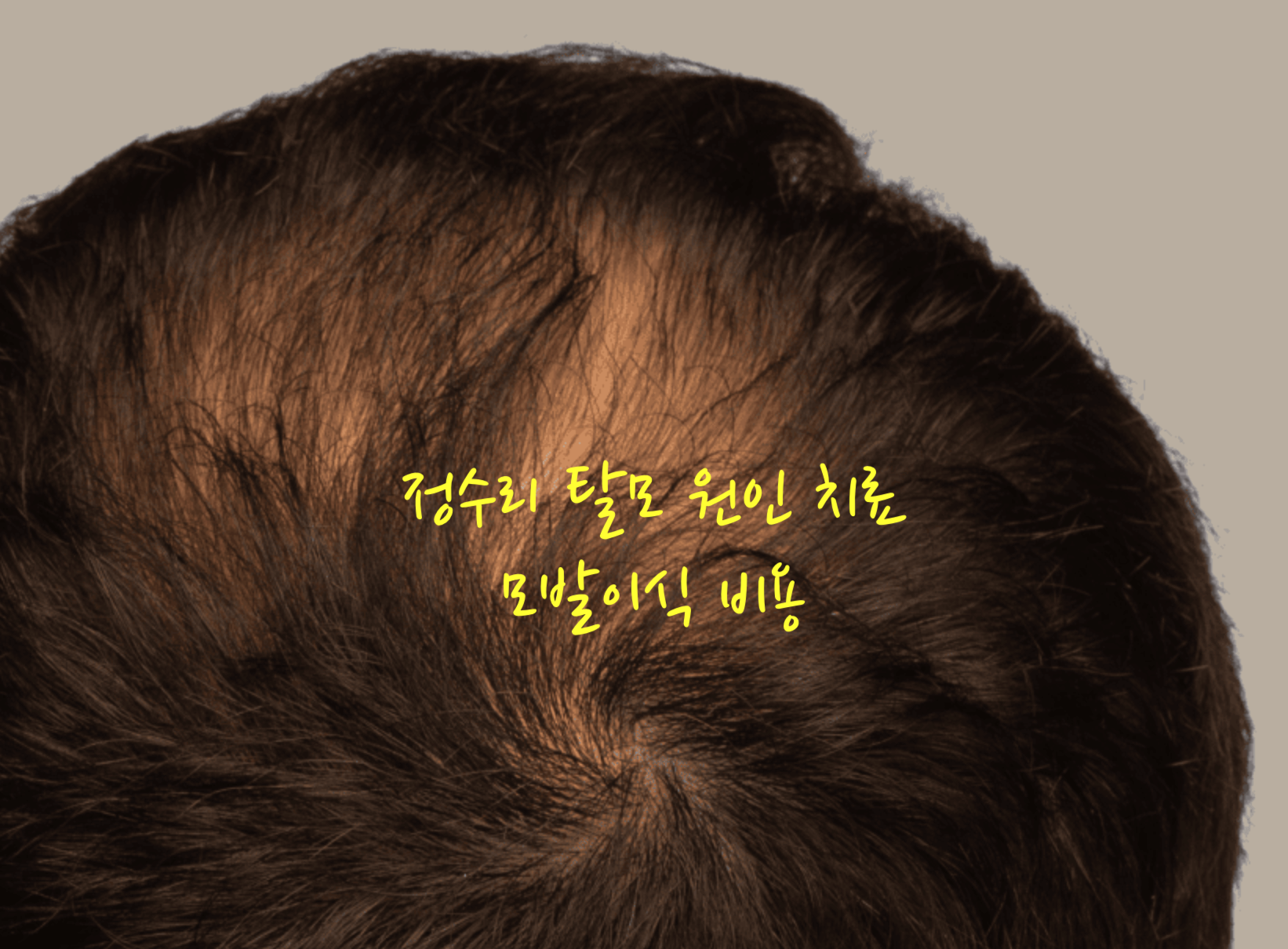 정수리 탈모