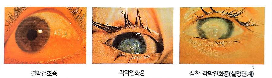 비타민 A 결핍으로 인한 안질환